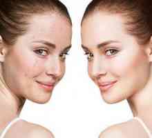Rupa na koži: uzroci i liječenje. Kako se riješiti post-acne
