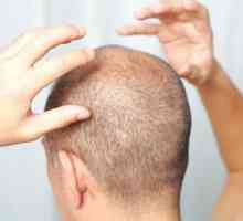 Folikulitis skalp: uzroci, simptomi, liječenje