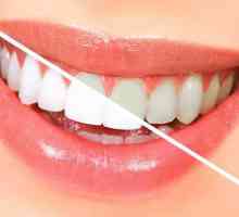 Fluorizacija zuba - što je to? Kako se provodi postupak dubokog fluoriranja zuba?