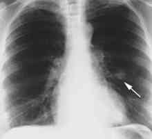 Hamartoma pluća: uzroci, simptomi, liječenje