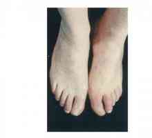 Gangrena noge: uzroci, simptomi i liječenje
