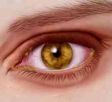 Herpes na oku: liječenje, uzroci, lijekovi