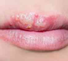 Herpes na usnama: kako se zauvijek izliječiti pučkim lijekovima? Je li moguće zauvijek izliječiti…
