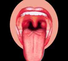 Herpes u jeziku. Uzroci i liječenje bolesti