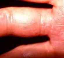 Herpes na rukama (herpetski krivac): uzroci, simptomi, liječenje