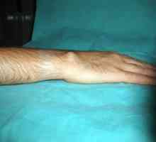 Hygroma wrists: liječenje bez kirurških narodnih lijekova (recenzija)