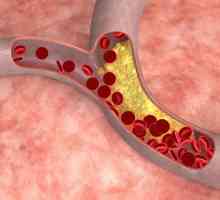 Hiperkolesterolemija je ... Povišeni kolesterol. Nasljedna hiperkolesterolemija