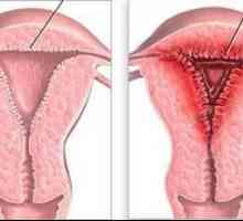 Hiperplazija endometrija: što je to? Uzroci, simptomi i metode liječenja