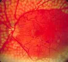 Hipertenzivna retinalna angiopatija: simptomi i režim liječenja