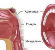 Hipertrofija adenoida - uzroci, stupnjevi, simptomi i liječenje