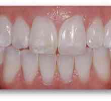Hipoplazija zubne cakline: dijagnoza i liječenje