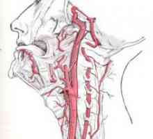 Hipoplazije lijeve vertebralne arterije. Uzroci. Simptomi. liječenje