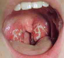 Ulcers na tonzilima bez temperature: foto, liječenje