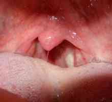 Ulceri u grlu: fotografija, kako liječiti?