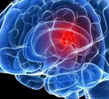 Glavobolja: tumor na mozgu. Prvi simptomi tumora mozga