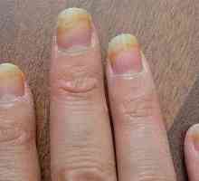 Gljiva na noktima ruku: opis bolesti i liječenja
