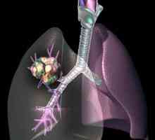 Kemoterapija za rak pluća. Kako liječiti rak pluća