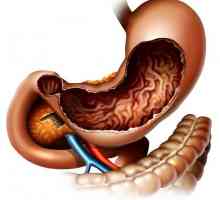 Kronični gastritis: liječenje, simptomi, dijagnoza, prehrana