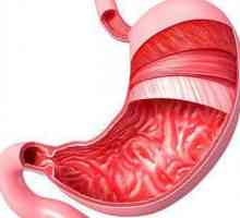 Kronični površinski gastritis: simptomi, liječenje, dijeta
