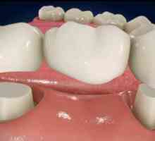 Implantat ili most - što je bolje? Dentalni implantati. Stomatološka protetika