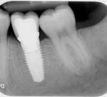 Implantacija zuba: kontraindikacije i moguće komplikacije (recenzije)