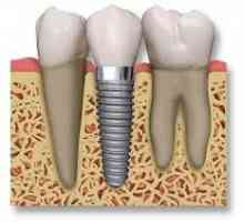 Implantati zuba: pregled pacijenata o operaciji