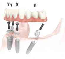 Implantati zubi: kontraindikacije, recenzije, štete