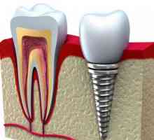 Implantati zubi: životni vijek, kontraindikacije, plusi i minusi