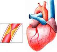 Infarkt srca je jedna od najčešćih bolesti ljudi