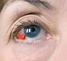 Moždani udar oka (okluzija): prvi znakovi, liječenje, posljedice