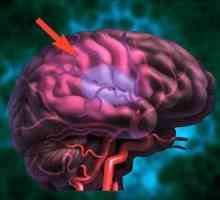 Moždani udar mozga: prevencija. Folk lijekovi za prevenciju moždanog udara