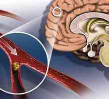 Moždani udar: znakovi i posljedice. Glavni simptomi moždanog udara i mikro moždanog udara