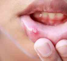 Ulcers in the mouth: uzroci i liječenje