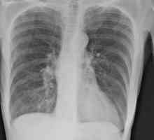 Emfizem pluća: liječenje i prognozu