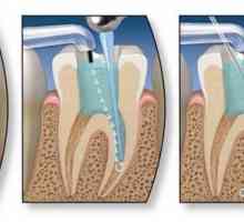 Endodontsko liječenje zuba. Faze endodontskog liječenja