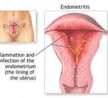 Endometrit maternice - što je to? Simptomi endometritisa kod žena. Ginekologija - endometritis