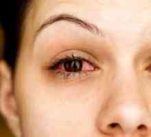 Episkleritis oka: znakovi, uzroci, liječenje