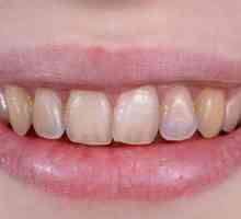 Erozija zuba: opis, uzroci, simptomi i značajke liječenja