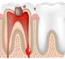 Faze liječenja pulpitis s lijekovima. Endodontsko liječenje