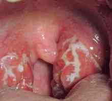 Kako postupati s herpesom u grlu?