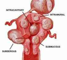 Kako liječiti mitom od uterusa bez operacije: metode, recenzije