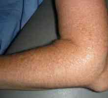 Kako liječiti grčevito zglob koljena?