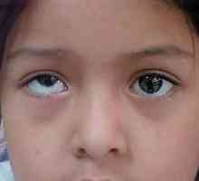 Koji je naziv bolesti kada oči gledaju u različitim smjerovima?