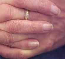 Kako prepoznati gljiva noktiju na nogama: simptomi, mogući uzroci i karakteristike liječenja