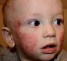 Kako se bolesti kože razvijaju kod djece