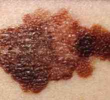 Kako prepoznati melanom u ranoj fazi? Znakovi i simptomi melanoma kože (foto)