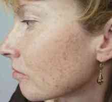 Kako ukloniti pigmentne mrlje na licu: narodni lijekovi