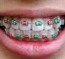 Koje su braces na zubima: vrste, značajke i recenzije