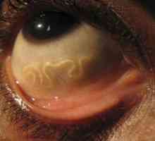 Koji su paraziti u očima čovjeka?