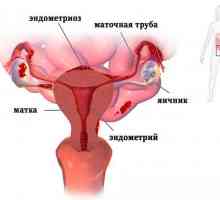 Što piti travu s endometriozom?